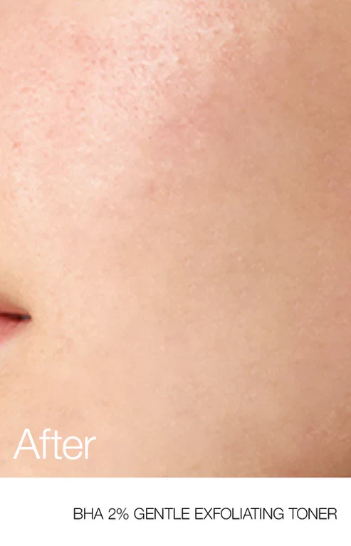 Anua BHA 2% Gentle Exfoliating Toner 150ml - Image 5