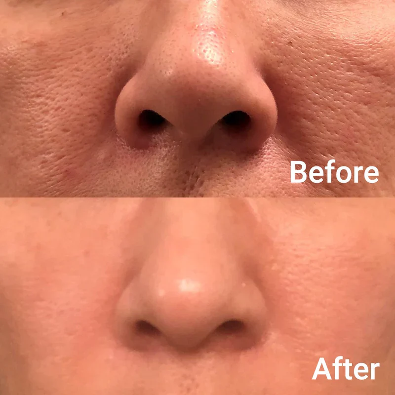 medicube - Zero Pore Pad 2.0 70 pads - Image 4