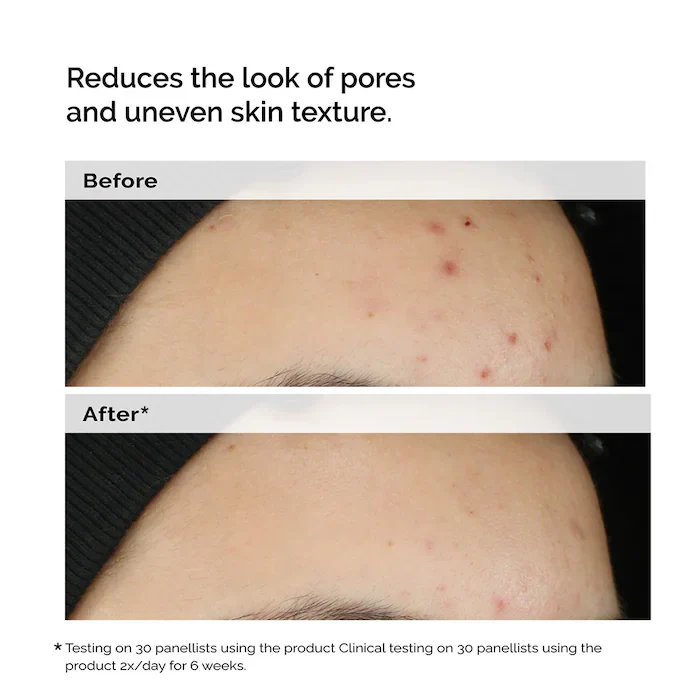 The Ordinary Balancing & Clarifying Serum -Suero equilibrante y aclarante para pieles con imperfecciones - Image 6