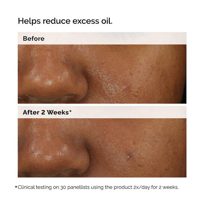 The Ordinary Balancing & Clarifying Serum -Suero equilibrante y aclarante para pieles con imperfecciones - Image 7