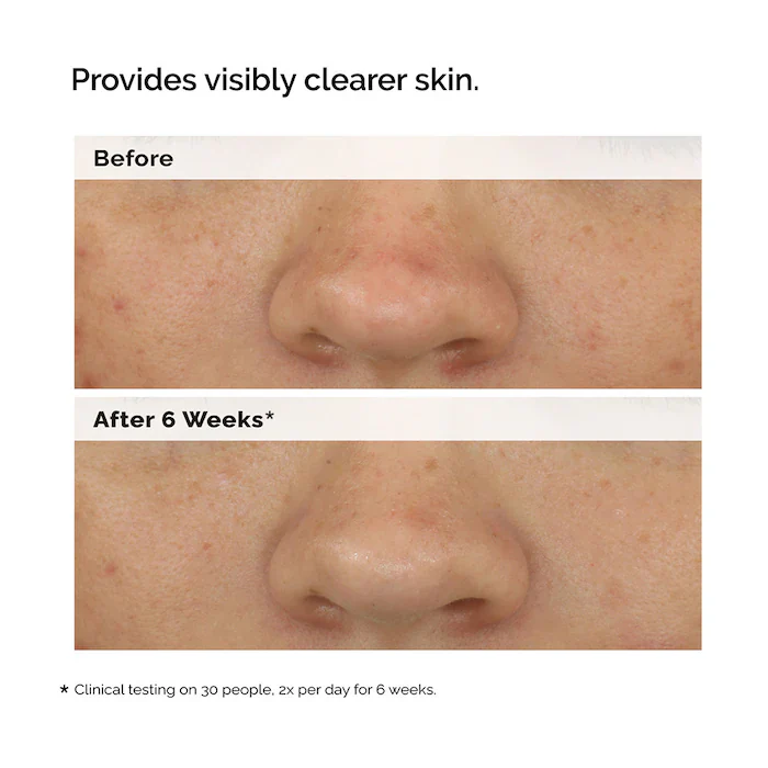 The Ordinary Balancing & Clarifying Serum -Suero equilibrante y aclarante para pieles con imperfecciones - Image 8